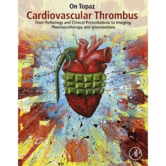 Cardiovascular Thrombus On Topaz