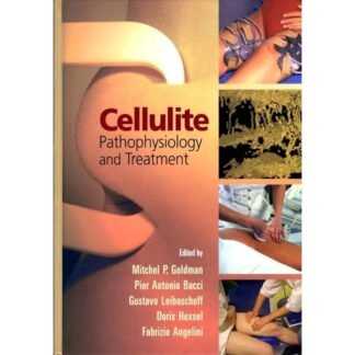 [Full Color /BW] Cellulite Pathophysiology and Treatment 2006